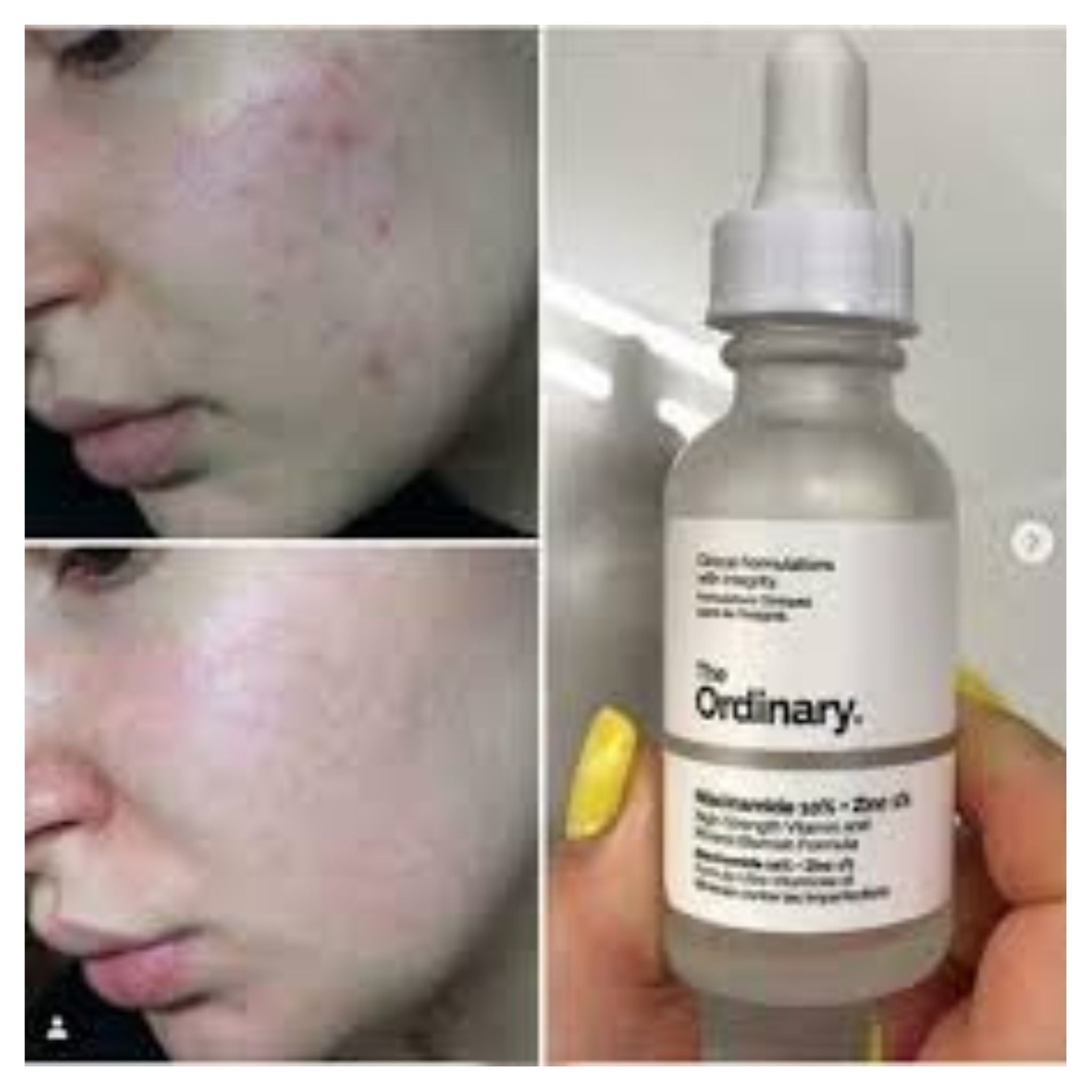 The Ordinary Niacinamide 10% + Zinc 1 % - 30ml