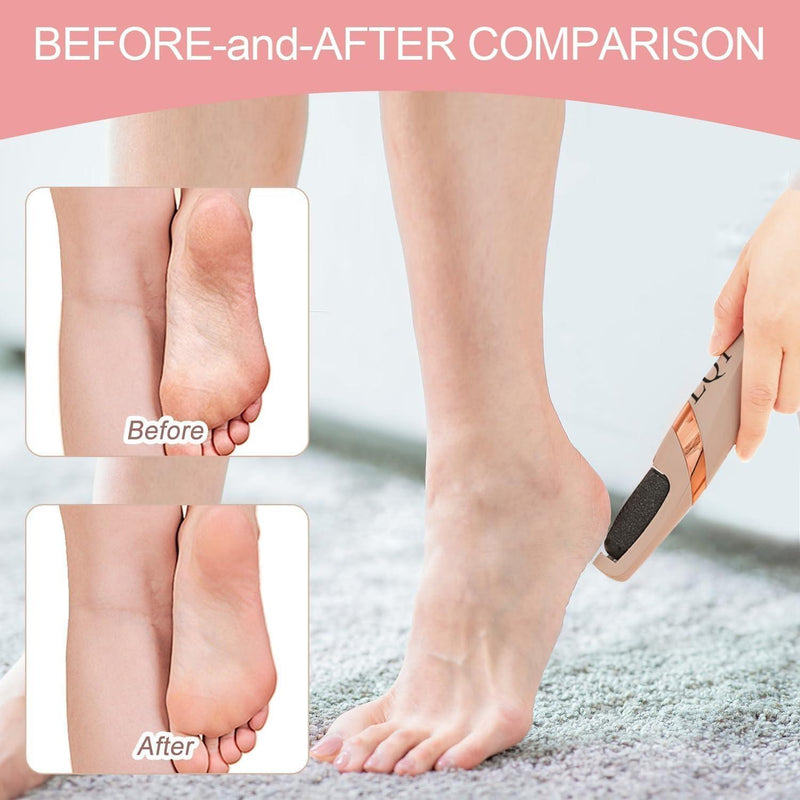 Before and after results of foot callus removal using electric foot file