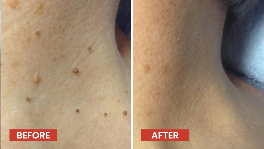 DermaSmooth Skin Tag Remover Patches – Fast, Safe, Painless Removal for Skin Tags and Moles with No Scars or Discoloration