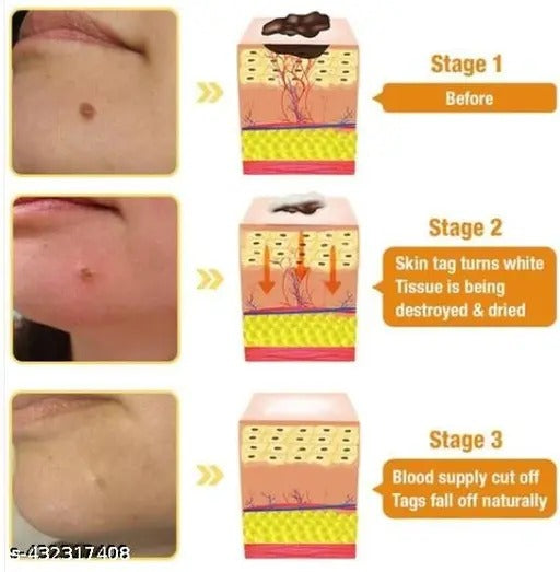 DermaSmooth Skin Tag Remover Patches – Fast, Safe, Painless Removal for Skin Tags and Moles with No Scars or Discoloration