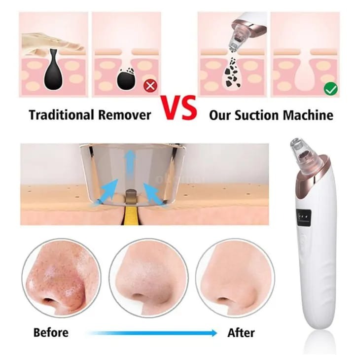 Before and after results of pore cleaner removing blackheads and cleaning skin pores