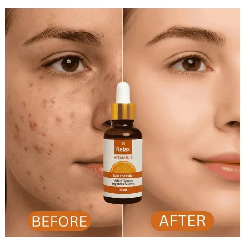 Before and after comparison of a face with acne treatment, featuring a bottle labeled 'Relax'.