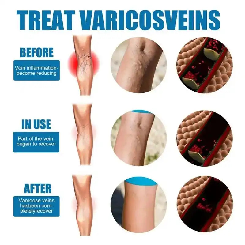 Before, during, and after treatment of varicose veins with close-up views of veins.