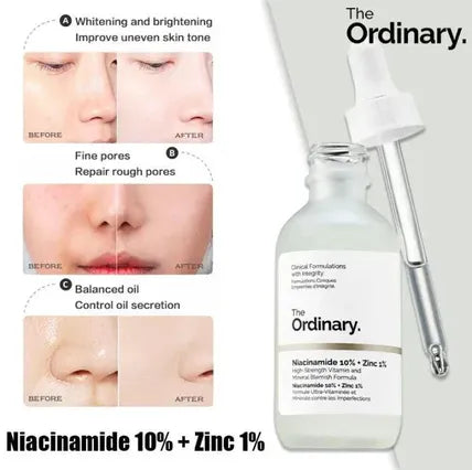 Before and after results of The Ordinary Niacinamide 10% + Zinc 1% Serum showing clearer, brighter, and smoother skin after regular use
